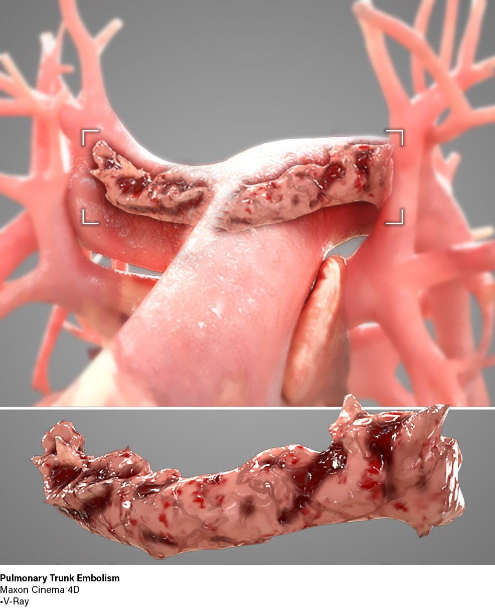 Pulmonary Trunk Embolism Render by Jason Laramie